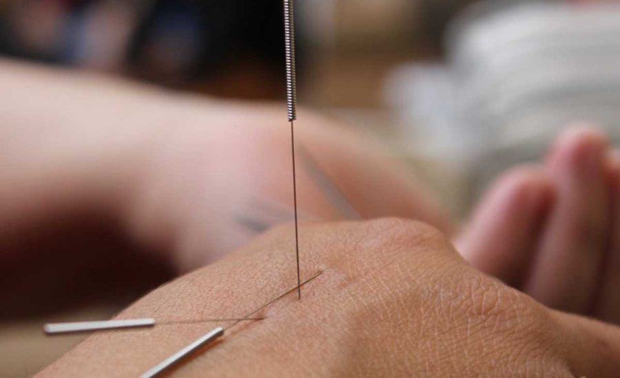 רפואה יפנית דיקור יפני