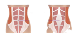 היפרדות בטנית דיאסטזיס רקטי