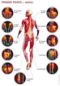 טיפול Trigger Points נטרול נקודות מעוררות כאב
