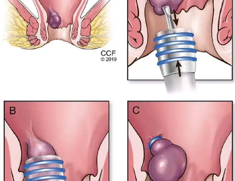 טיפול בטחורים מודיעין מכבים רעות - מרפאת אור הנר
